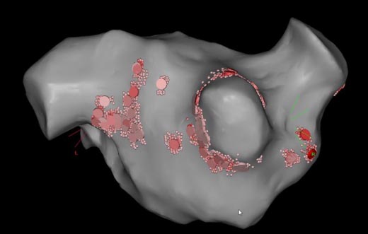 Hanks ablation spots - Hank's Heart